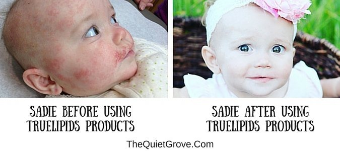 6 Steps to properly treat Eczema