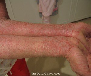 How to Properly Treat Eczema and reclaim your life.